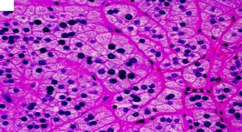 Adrenal Cortical Adenoma Showing Characteristic Microvascular Cytoplasm Download Scientific