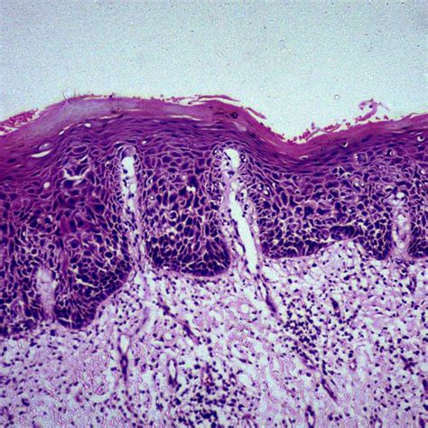 A Keratosis With Moderate Epithelial Dysplasia Hematoxylin And Eosin