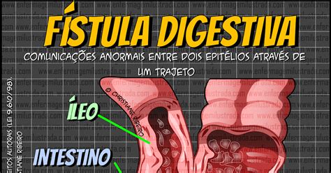 Fístula Digestiva Enfermagem Ilustrada