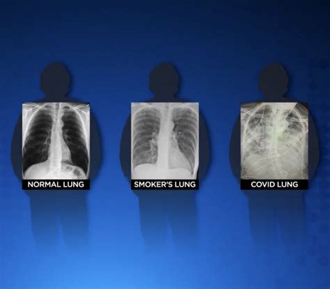 X Ray Of Smokers Lungs SEE This Is What Your Lungs Look Like When You