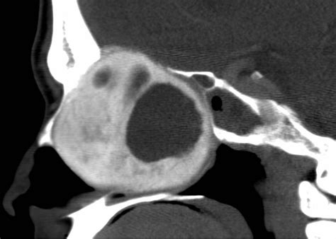 Cemento Ossifying Fibroma Image