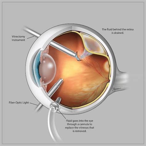 Retinal Detachment Laser Treatment And Surgery Synergy Eye Care