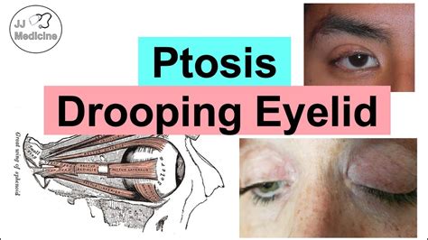 Ptosis Drooping Eyelid Eye Anatomy Causes Associated Conditions