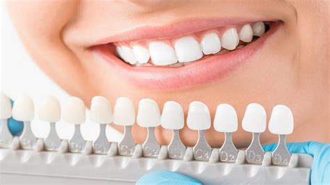 Dental Veneers London Ontario Everything You Should Know