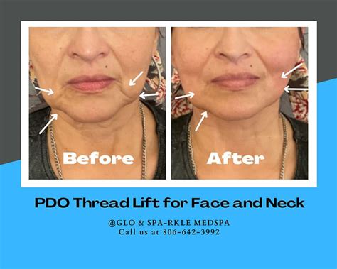 Before After PDO Thread Lift Procedures In Lubbock Glo Sparkle