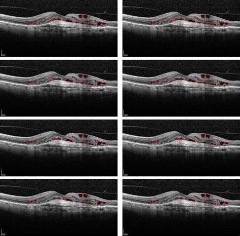 Computerized Assessment Of Intraretinal And Subretinal Fluid Regions In Spectral Domain Optical