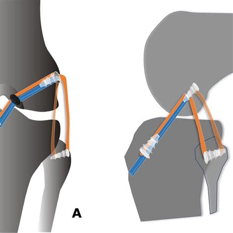 Pdf Combined Anterior Cruciate And Lateral Collateral Ligaments Reconstruction With