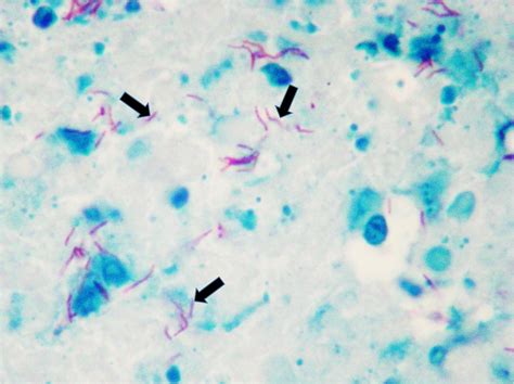 Acid Fast Staining Principle And Procedure