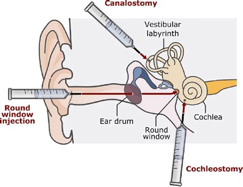 Gene Therapy Cures Deafness