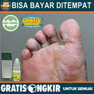 Jual Obat Kutu Air Untuk Kaki Kutu Air Di Tangan Obat Gatal Dan Kutu