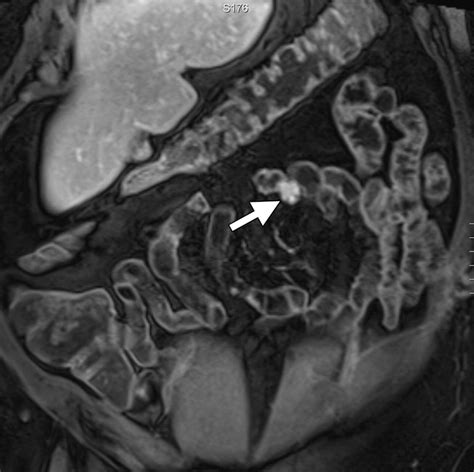 Effectiveness Of Mr Enterography For The Assessment Of Small Bowel