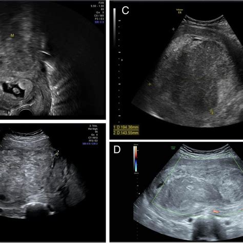 Ultrasound examinations of the fibroids during pregnancy. a Ultrasound ...