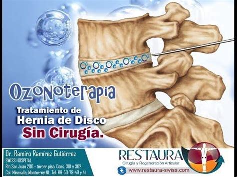 Uso De Ozonoterapia En Articulaciones Hernia De Disco Y Columna