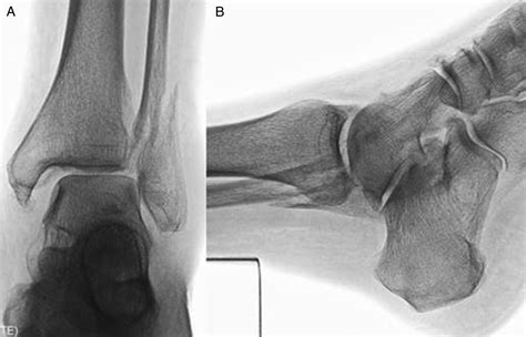 Two View Gravity Stress Imaging Protocol For Nondisplaced Type Ii