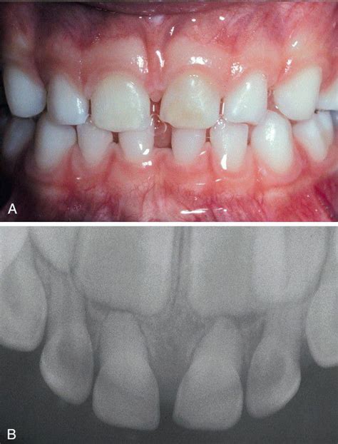 Calcific Metamorphosis Medizzy