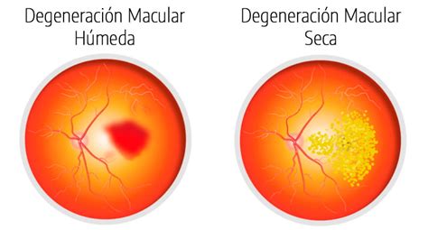 Degeneración macular Elige al especialista adecuado Clínica de Ojos