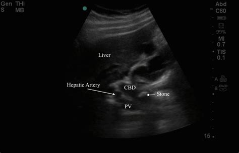 Fever and RUQ pain 5 years after cholecystectomy? | Emory School of ...