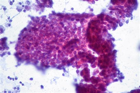 Papillary Thyroid Carcinoma Fna Rapid Pap Stain The Nucl Flickr