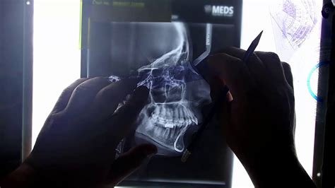 Ep1manual Cephalometric Tracing Level 1 Youtube