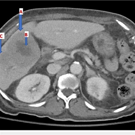 Ct Of The Abdomen And Pelvis Depicting Two Hypoenhancing Masses Arrow