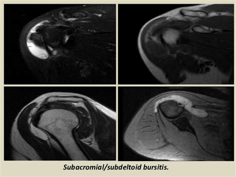 MRI Musculo-Skeletal Section: Bursa of shoulder.