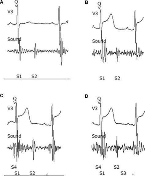 Electrocardiographic And Acoustic Cardiographic Changes In Lead V3 At