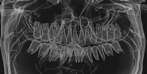 Why Do Dentists Perform X Rays Eagle Rock Dental Care