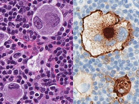 EBV CHL Left RS And H Cells H E Stain Right CD30 Membranous