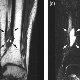 (PDF) MRI of chondromyxoid fibroma