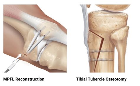 Tibial Tubercle Osteotomy