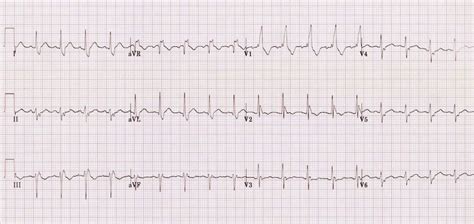 Ecg Showing Bifascicular Block Left Anterior Fascicular Block And Download Scientific Diagram