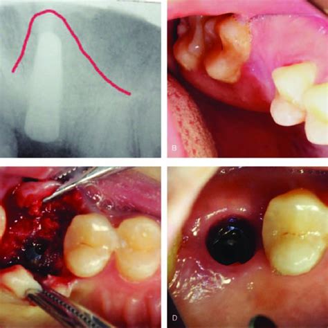 Postoperative Photos Of Case 1 A Periapical Radiographs Aspect 6