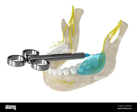 Mandibular Arch With Buccal Nerve Block Types Of Dental Anesthesia