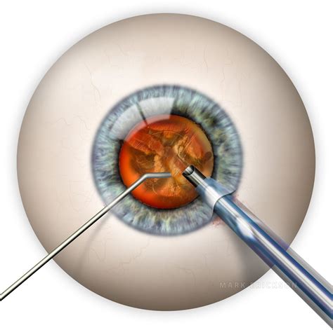 Phacoemulsification Of A Cataract Lens Nucleus