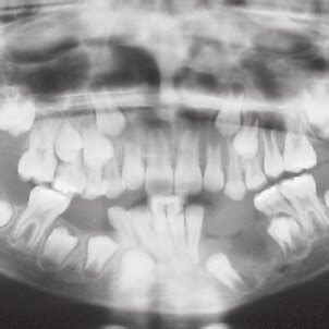 Panoramic Radiograph Showing Multilocular Lesions In The Mandible No