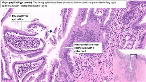 Ampulla Normal Histology Nus Pathweb Nus Pathweb