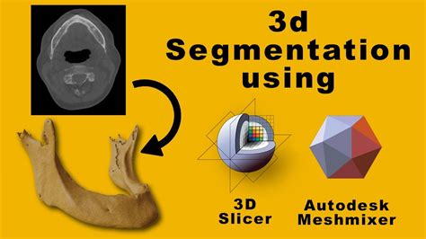 3D Segmentation Workshop - Dicom to STL model using 3D slicer - YouTube