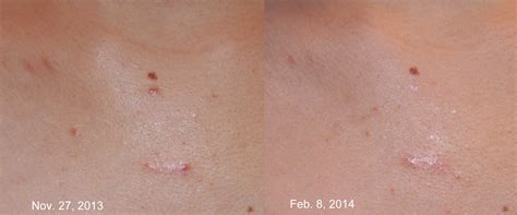 Keloid Treatment - Keloid Removal Expert - New York