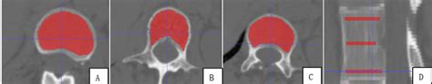 The Measurement With Drawing An Elliptical Roi On Conventional Lumbar Download Scientific