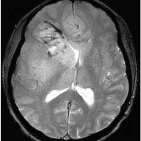 Basal Ganglia Anatomy Ct