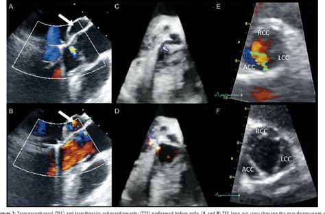 PDF Pseudoaneurysm Of The Mitral Aortic Intervalvular Fibrosa As A