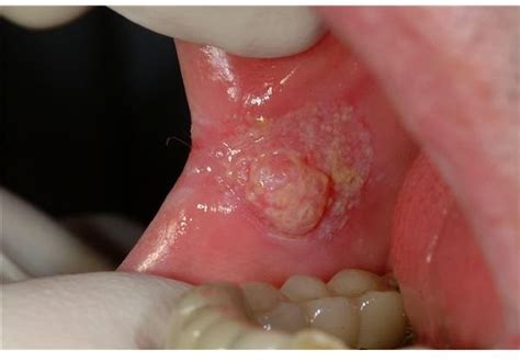 What Does Oral Cancer Look Like In The Mouth Or Cheek