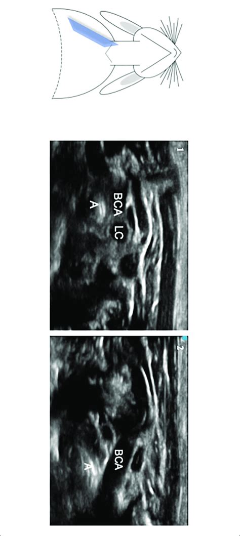 Oblique Parasternal And Midclavicular Plane Of The Thoracic