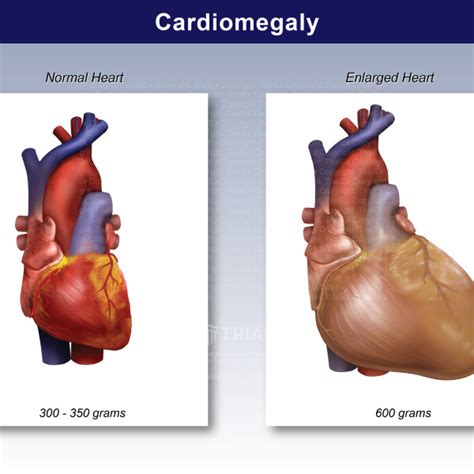 Cardiomegaly Trialexhibits Inc