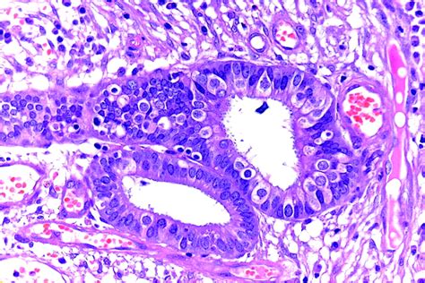 Endometrial Metaplasias And Reactive Changes A Spectrum Of Altered