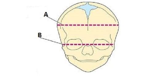 Fetal Skull - New