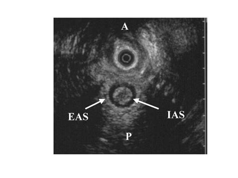 For Comparison An Endo Vaginal Ultrasonographic View Of A Normal Anal