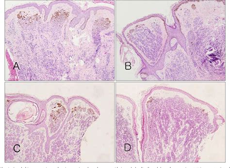 Intradermal Nevus Histology