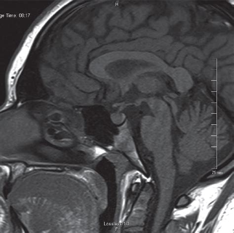 Figure 1 From Diagnostic Challenges And Considerations Of Cyclical