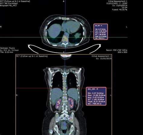 Deep Learning Approaches For Bone And Bone Lesion Segmentation On Fdg